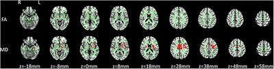 White Matter Integrity Involvement in the <mark class="highlighted">Preclinical Stage</mark> of Familial Creutzfeldt–Jakob Disease: A Diffusion Tensor Imaging Study